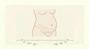 vergetures grossesse prévention